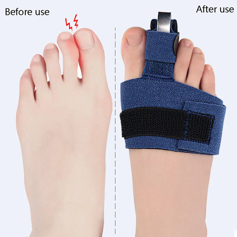 BunioFix™ Toe Corrector – Adjustable Bunion Relief & Comfort Support